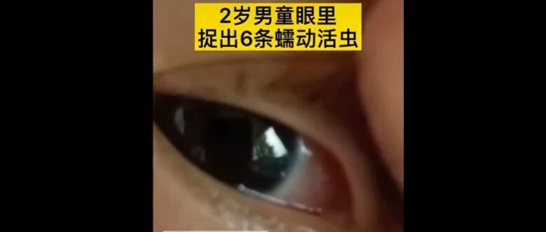 头皮发麻！2岁男童眼里竟捉出6条活虫！有这些习惯的赶紧改…
