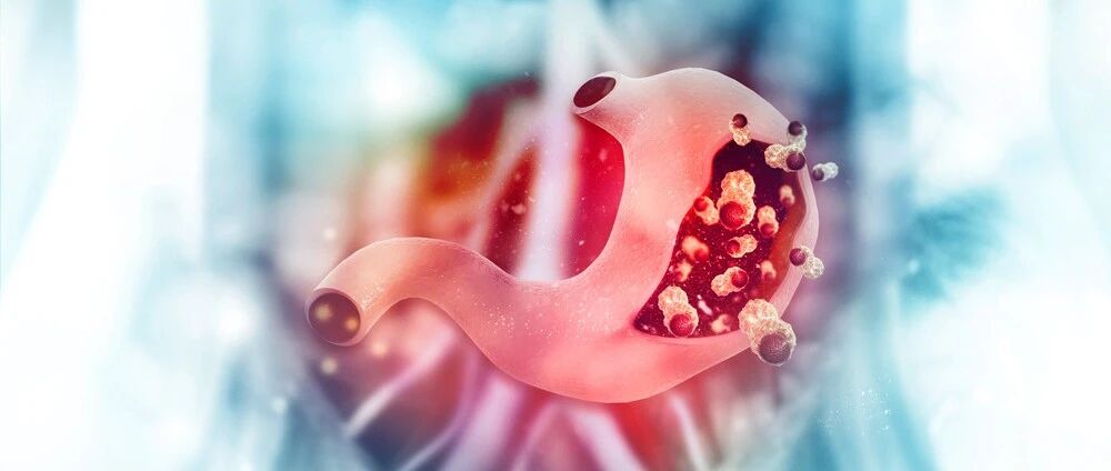 它是胃癌的"帮凶"，几乎每2个人中就有1个中招！这样做能预防…