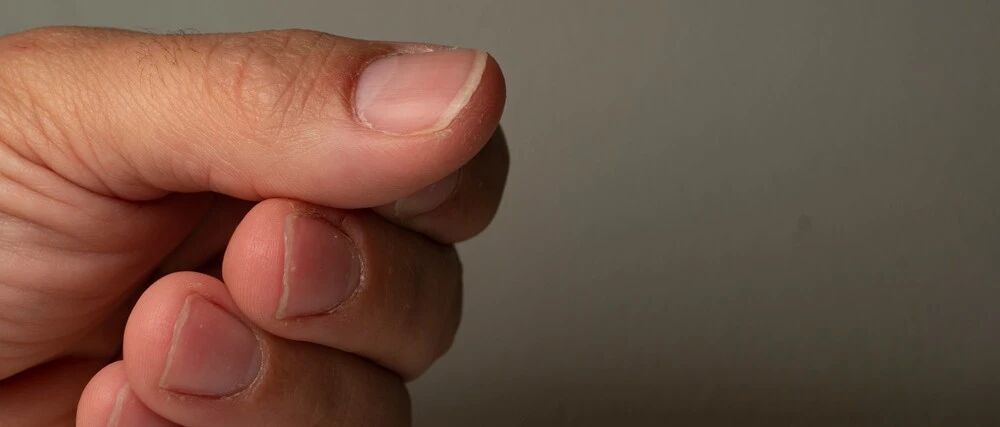 涨知识！原来指甲有斑点、竖纹、变厚竟预示着这些病…