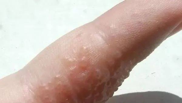 痒痒痒痒痒！一到夏天就长磨人的"小水泡"？今天就告诉你怎么治
