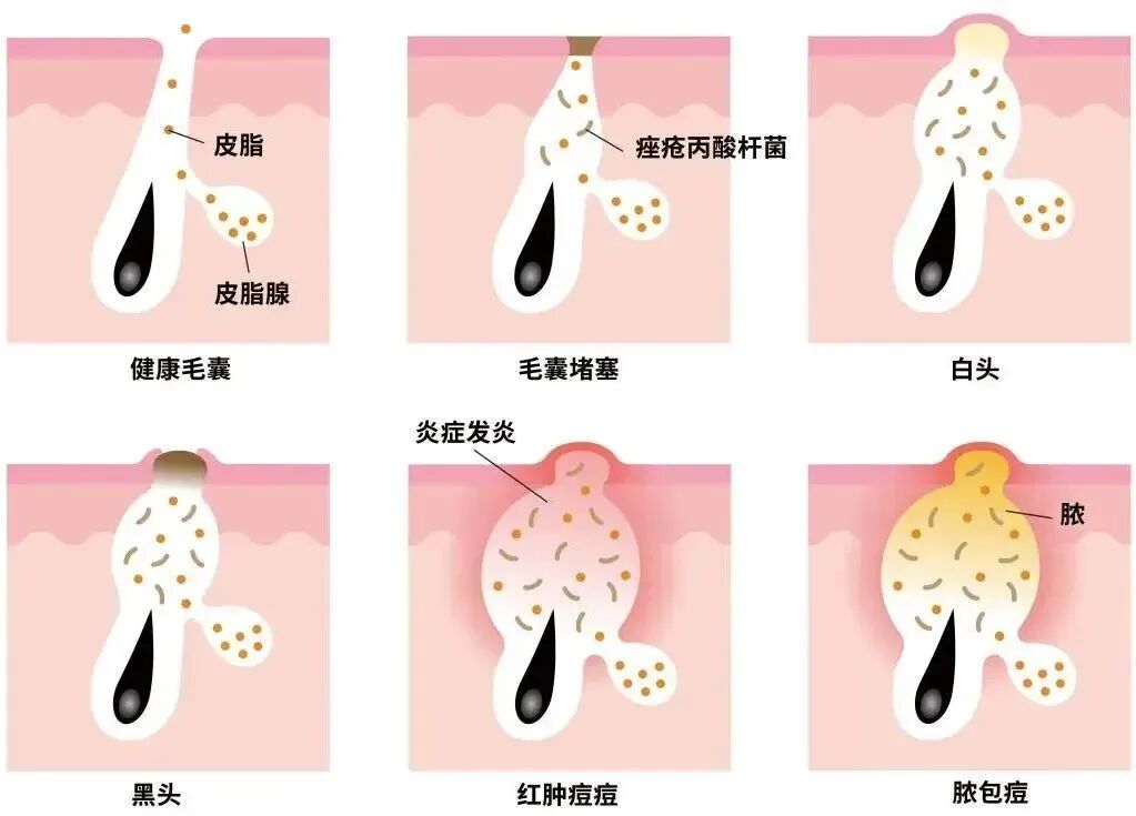 痘痘怎么治疗