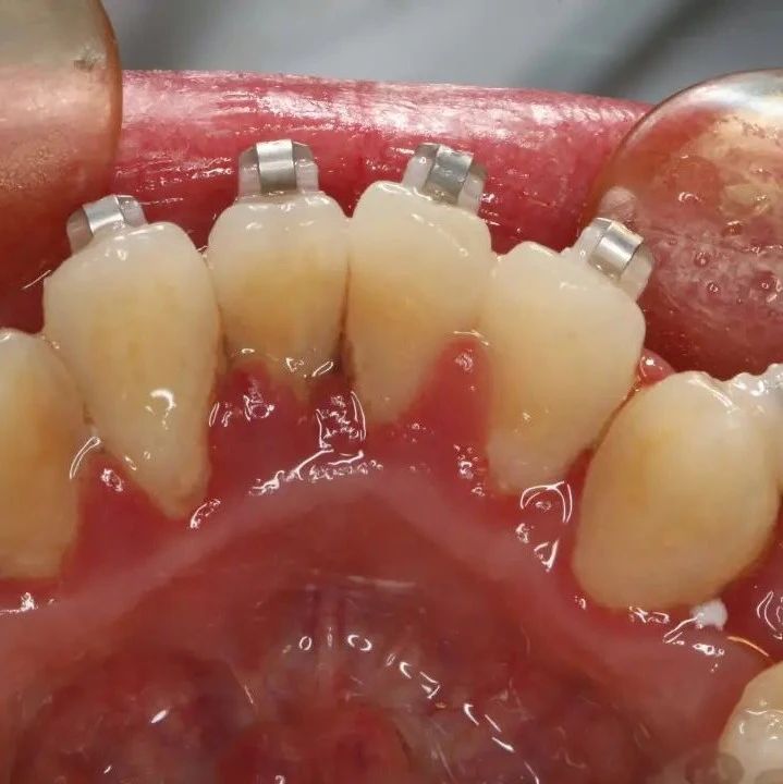 口腔正畸 | 牙周病患者可以正畸吗？