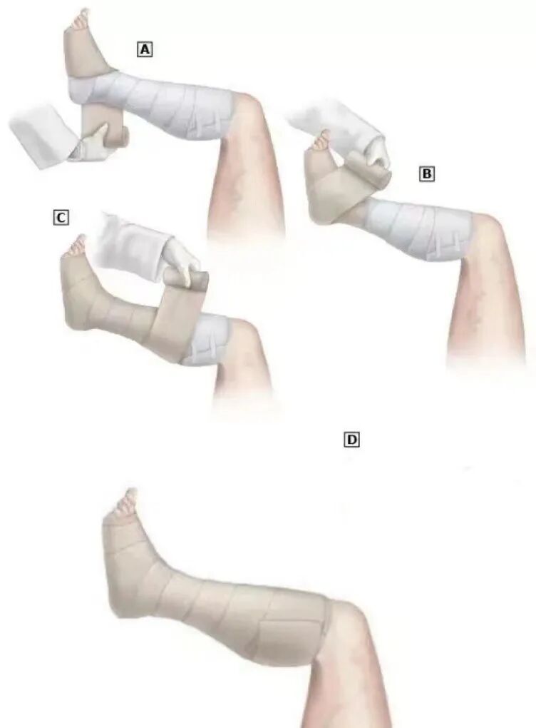 压力绷带为什么那么贵弹力绷带的正确使用方法_https://www.jmylbn.com_新闻资讯_第9张