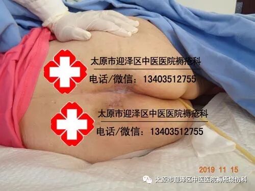 垫疮怎么治疗【褥疮烧伤科】什么办法可以治愈老人身上的褥疮_https://www.jmylbn.com_新闻资讯_第2张