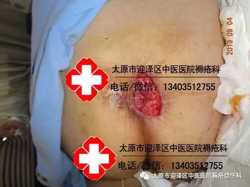 垫疮怎么治疗【褥疮烧伤科】什么办法可以治愈老人身上的褥疮_https://www.jmylbn.com_新闻资讯_第1张