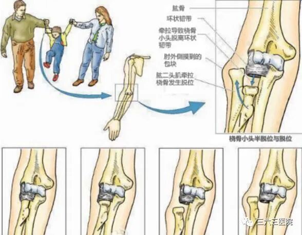 ５岁以下幼儿关节易脱臼 这些知识家长应掌握 特色技术 特色医疗 航空工业三六三医院 官方网站