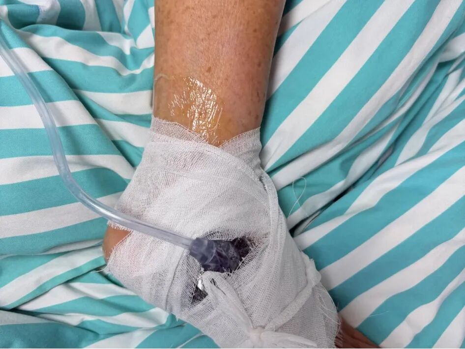 vsd引流器怎么连接【健康科普】负压封闭引流术--伤口的“高级吸尘器”，让伤口愈合更轻松_https://www.jmylbn.com_新闻资讯_第4张