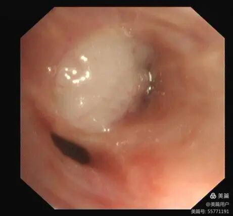 氩气刀是什么电子支气管镜下氩气刀治疗---打通呼吸通道，让气流畅通无阻_https://www.jmylbn.com_新闻资讯_第10张