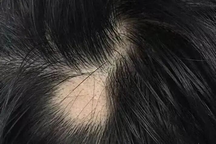 常见的斑秃治疗方法有哪些？