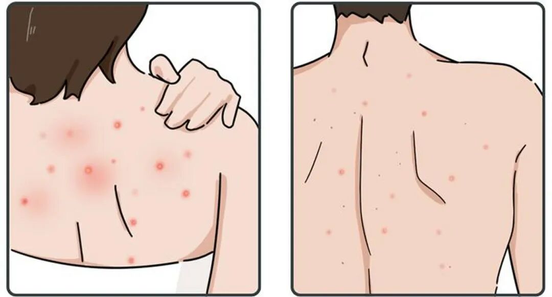 患上毛囊炎怎么办？毛囊炎的治疗方法又有哪些？