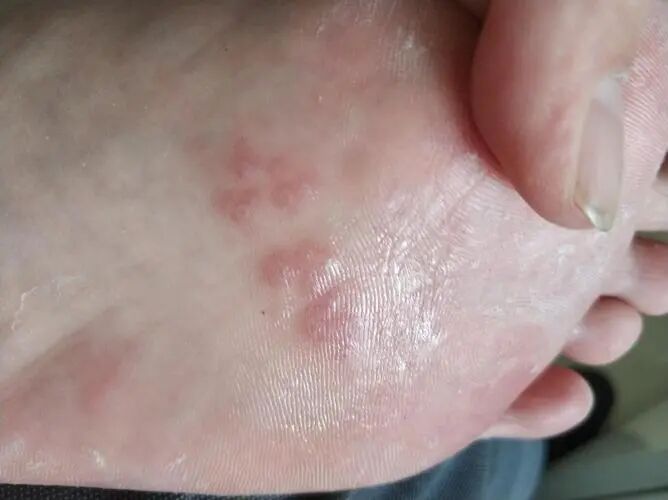 手足癣有哪些常见的治疗方法？