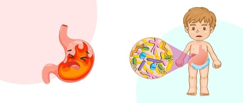 幽门螺杆菌最全科普，看完你就全懂了