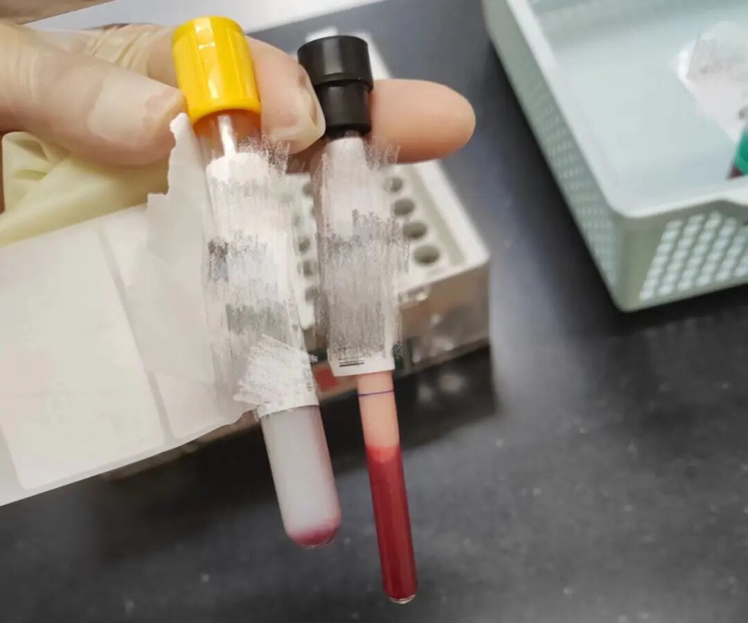 沃芬血气分析仪怎么样【东医技术】糖尿病的致命一击  重症医学科医疗团队为生命“守门”_https://www.jmylbn.com_新闻资讯_第3张