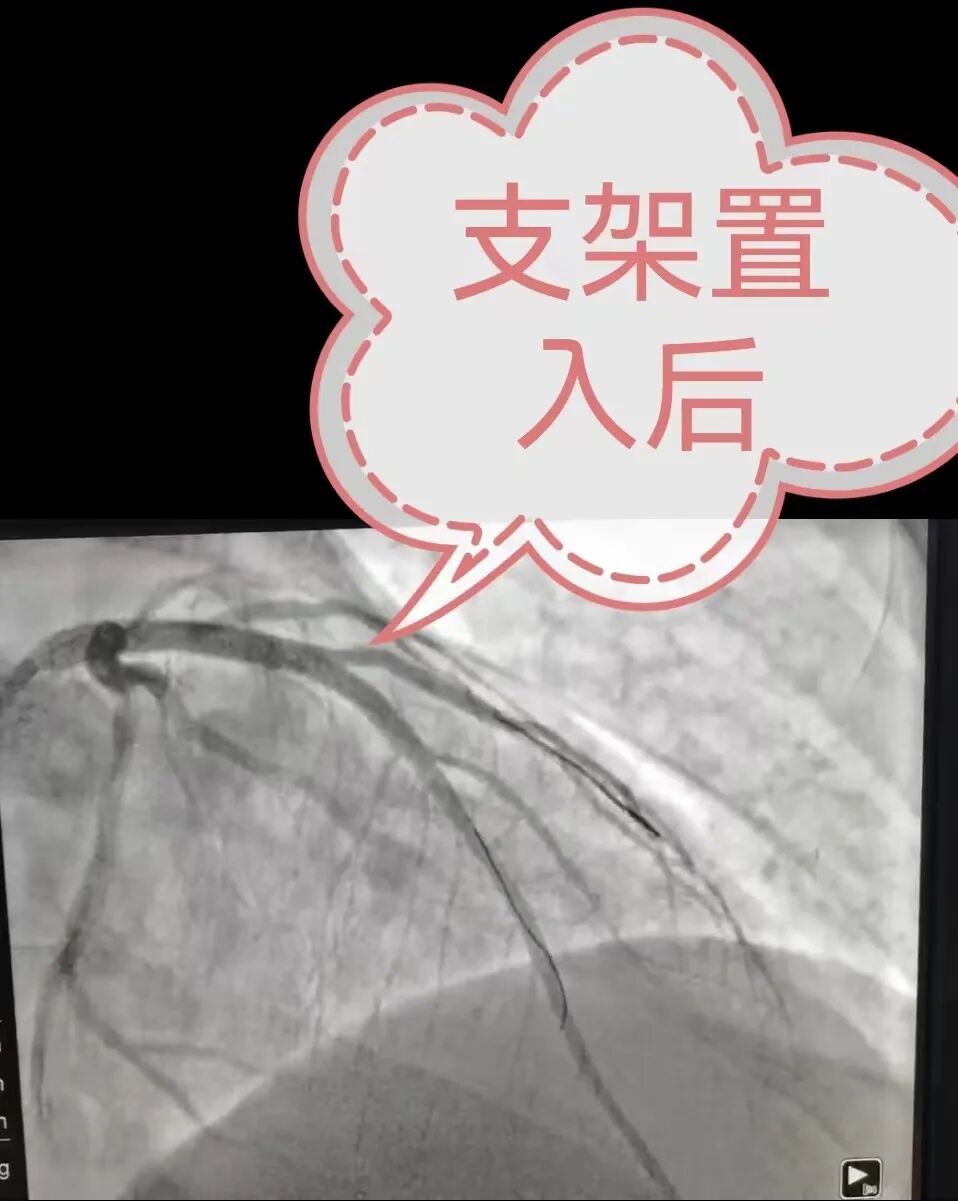 心电图机平板怎么使用在“跑步机”上也能诊断冠心病？聊城三院专家为您揭秘。_https://www.jmylbn.com_新闻资讯_第4张