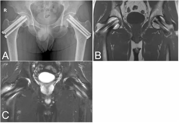 年轻男性自发性双侧股颈骨折