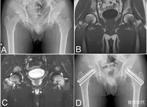 年轻男性自发性双侧股颈骨折