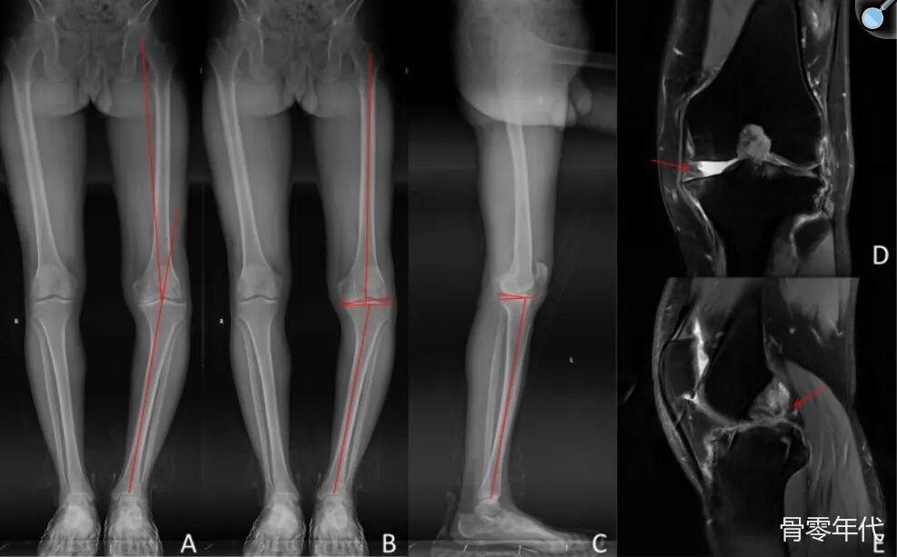 单间室膝关节置换术联合后交叉韧带重建