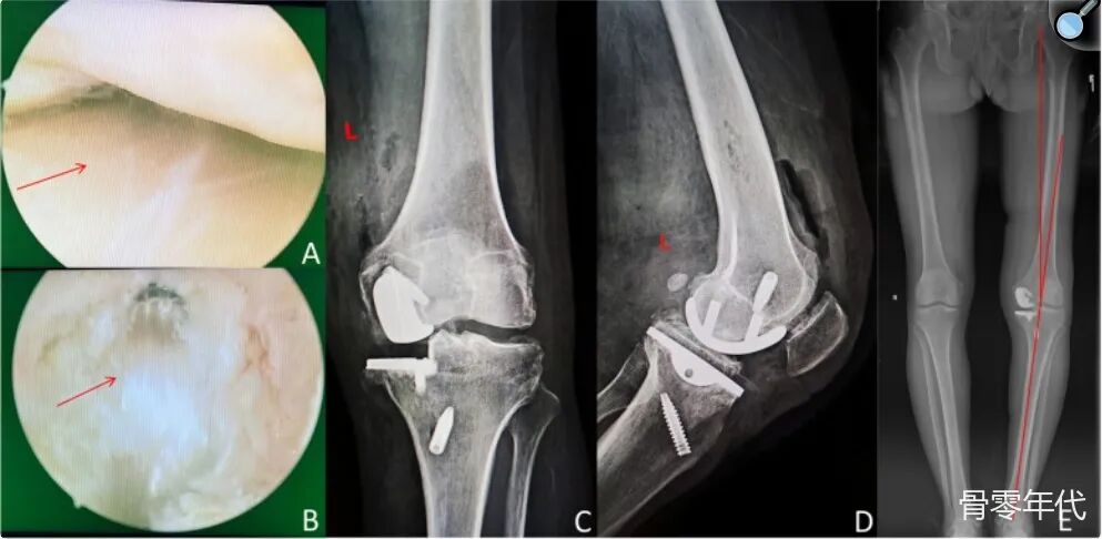 单间室膝关节置换术联合后交叉韧带重建
