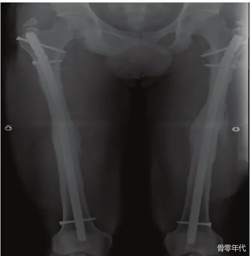 多发性创伤患者的漂浮肘：时机和手术策略