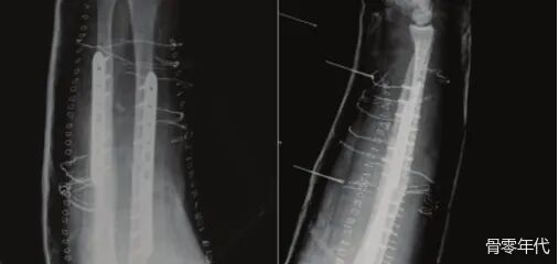 多发性创伤患者的漂浮肘：时机和手术策略