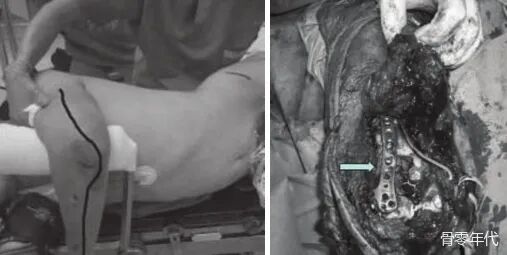 多发性创伤患者的漂浮肘：时机和手术策略