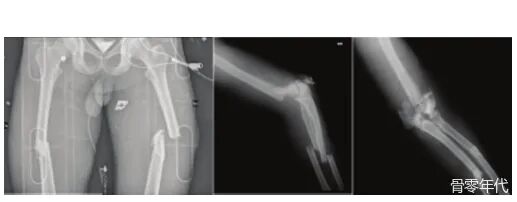 多发性创伤患者的漂浮肘：时机和手术策略