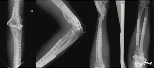 多发性创伤患者的漂浮肘：时机和手术策略