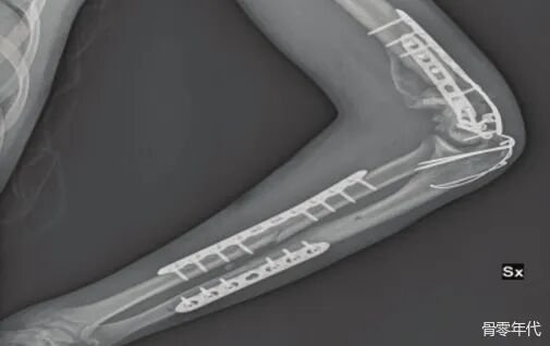 多发性创伤患者的漂浮肘：时机和手术策略