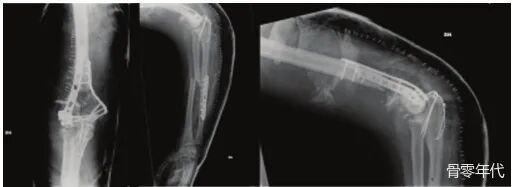 多发性创伤患者的漂浮肘：时机和手术策略