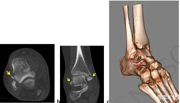 距腓前韧带撕脱性距骨骨折