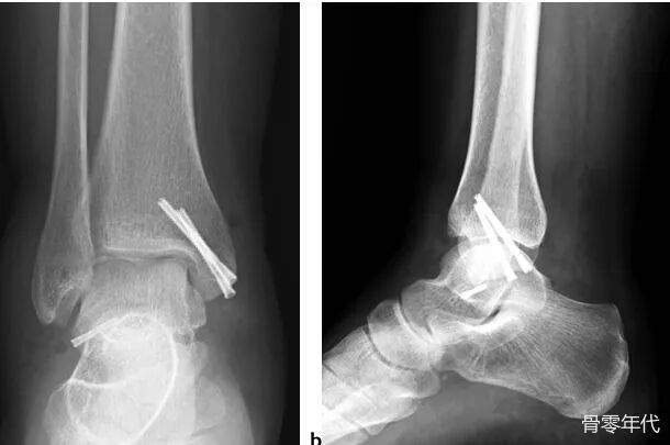 距腓前韧带撕脱性距骨骨折