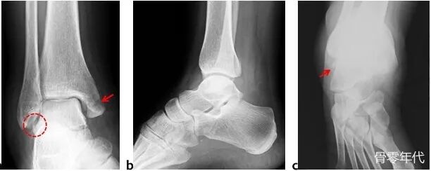 距腓前韧带撕脱性距骨骨折