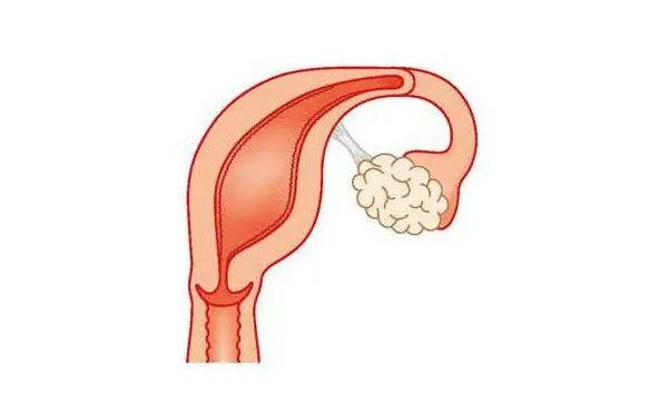 试管移植成功后，黄体酮保胎需要用多久?