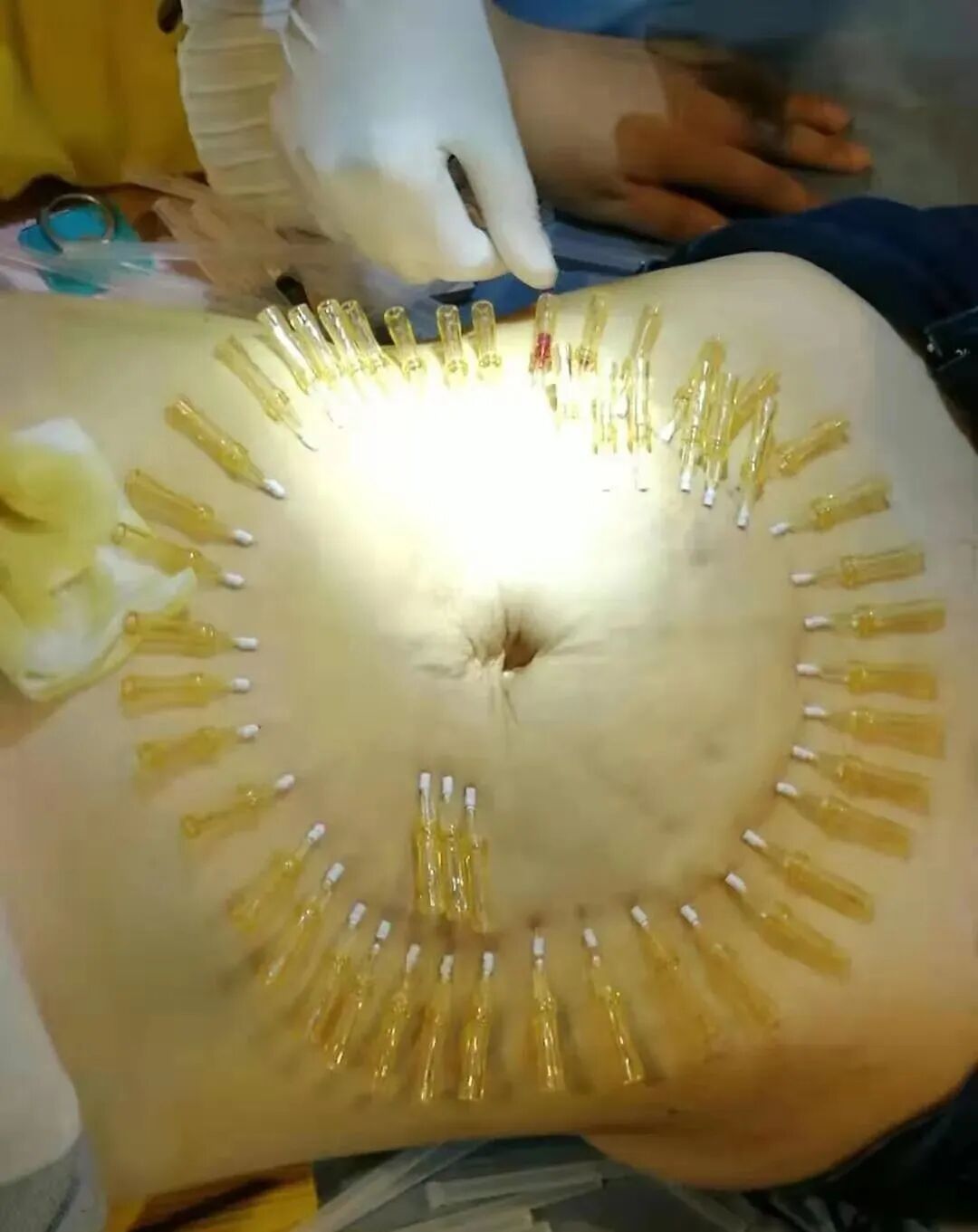 4月5日广州站针刀减肥针灸减肥拨针减肥埋线减肥