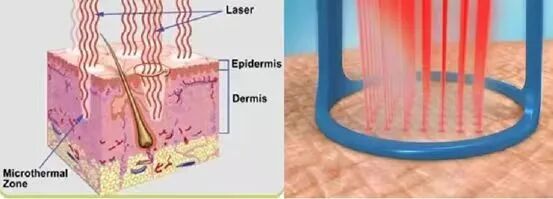 二氧化碳(co2)激光治疗是什么瘊⼦？疣？不要瞎折腾，快来试试“时光橡皮擦”——二氧化碳点阵激光！_https://www.jmylbn.com_新闻资讯_第1张