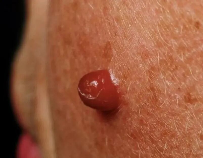 二氧化碳(co2)激光治疗是什么瘊⼦？疣？不要瞎折腾，快来试试“时光橡皮擦”——二氧化碳点阵激光！_https://www.jmylbn.com_新闻资讯_第4张