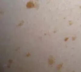 二氧化碳(co2)激光治疗是什么瘊⼦？疣？不要瞎折腾，快来试试“时光橡皮擦”——二氧化碳点阵激光！_https://www.jmylbn.com_新闻资讯_第3张