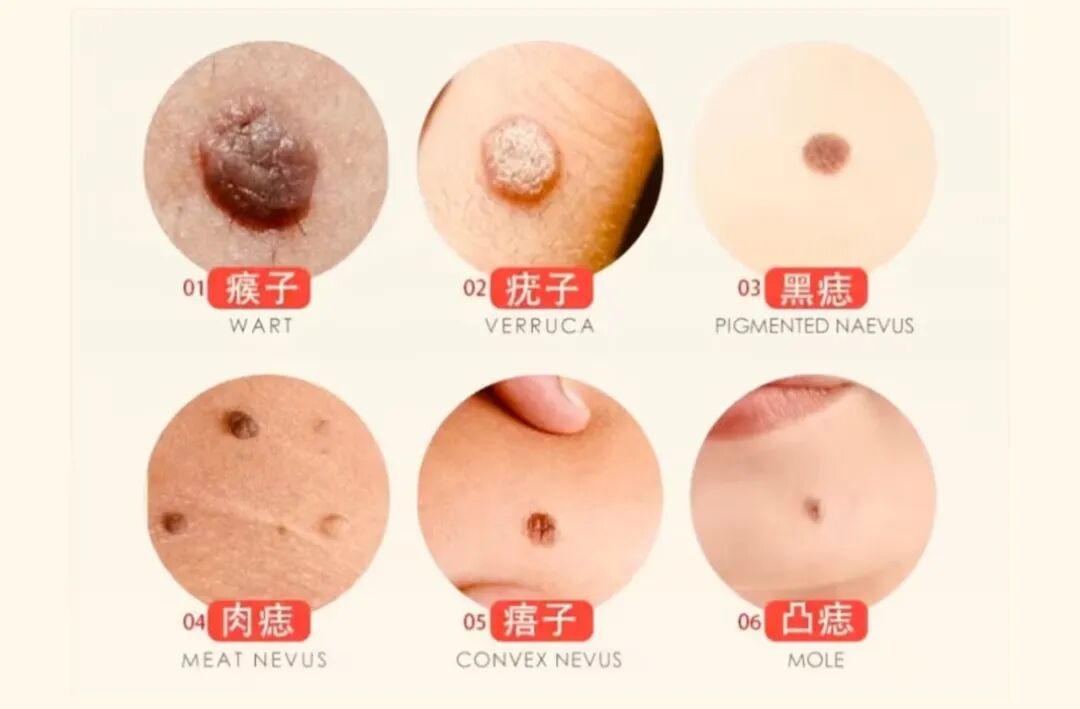 二氧化碳(co2)激光治疗是什么瘊⼦？疣？不要瞎折腾，快来试试“时光橡皮擦”——二氧化碳点阵激光！_https://www.jmylbn.com_新闻资讯_第2张