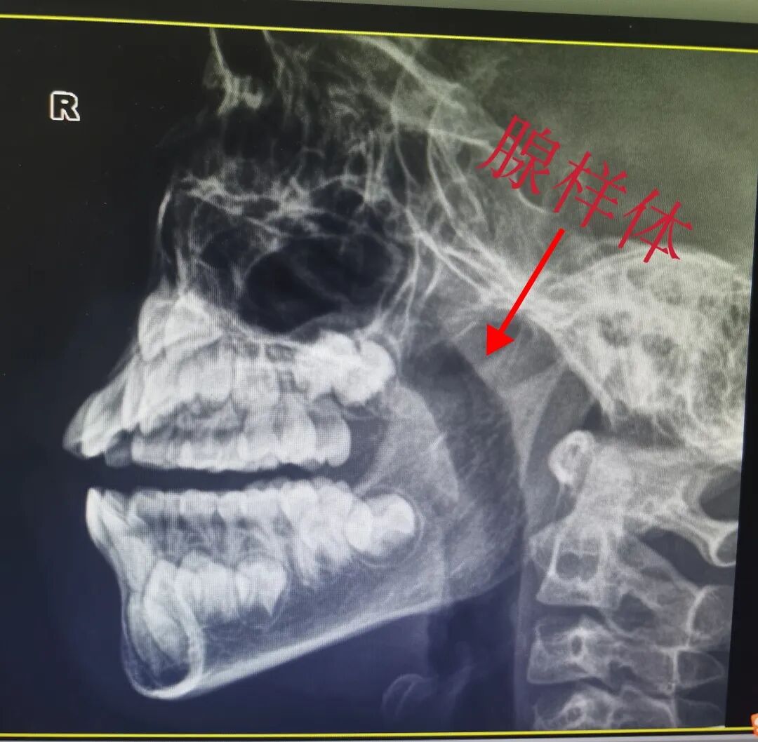 微波可以治疗什么耳鼻喉科的微波治疗到底是个啥？_https://www.jmylbn.com_新闻资讯_第11张