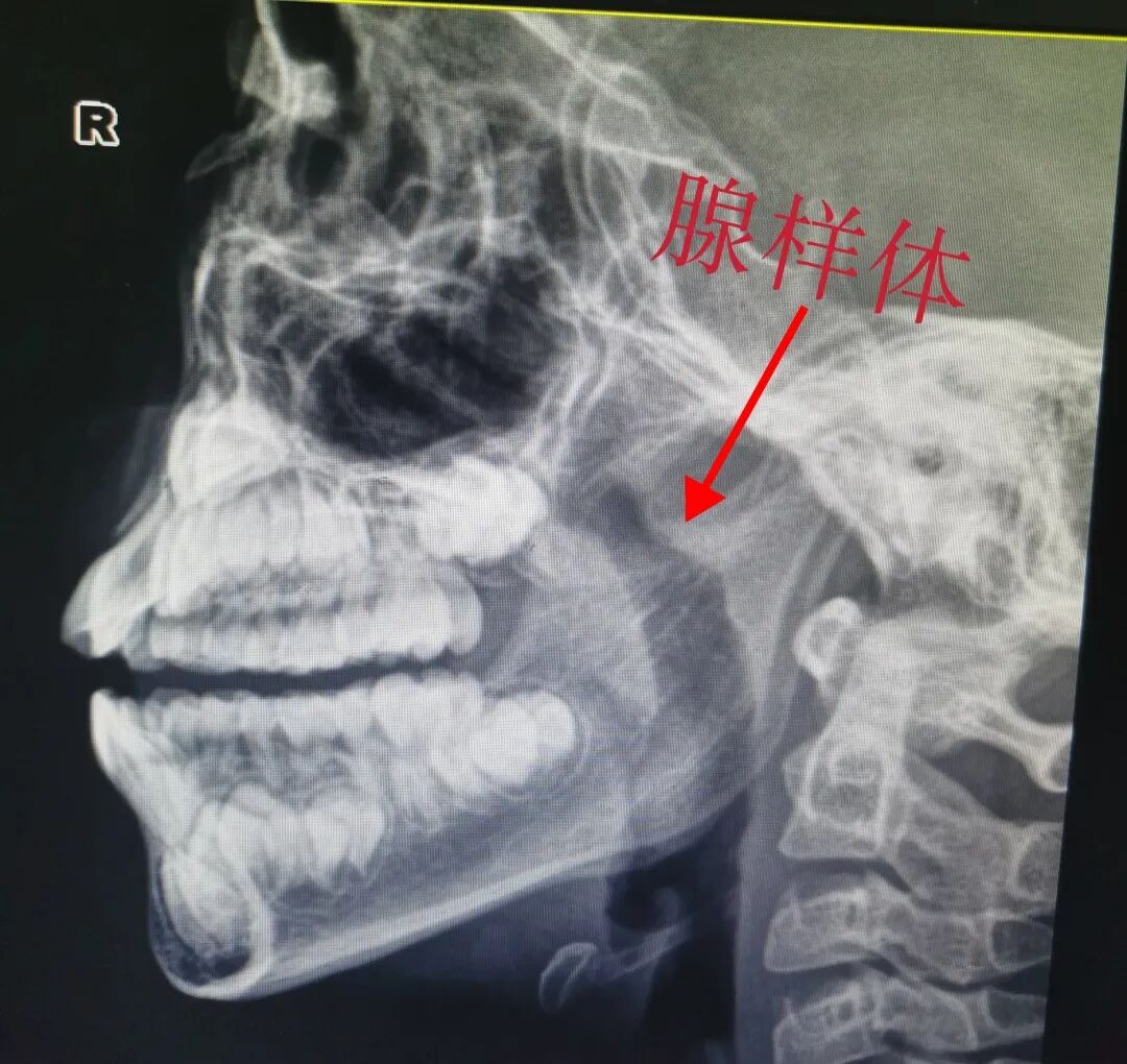 微波可以治疗什么耳鼻喉科的微波治疗到底是个啥？_https://www.jmylbn.com_新闻资讯_第10张