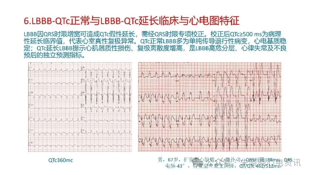 左束支阻滞再认识，实在太全了！