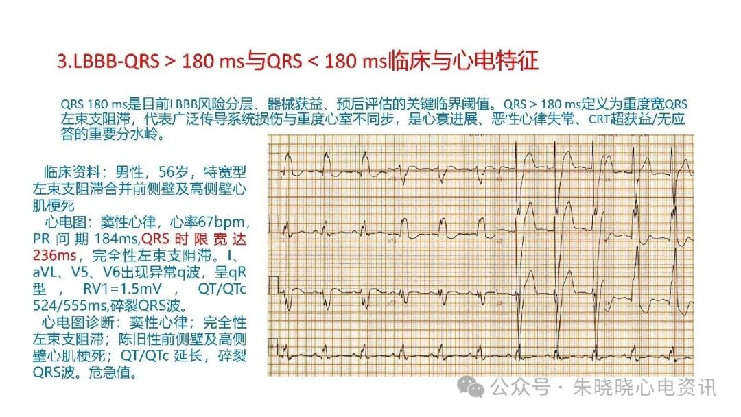 左束支阻滞再认识，实在太全了！