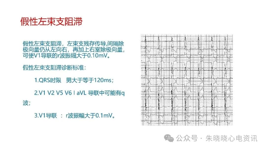 左束支阻滞再认识，实在太全了！