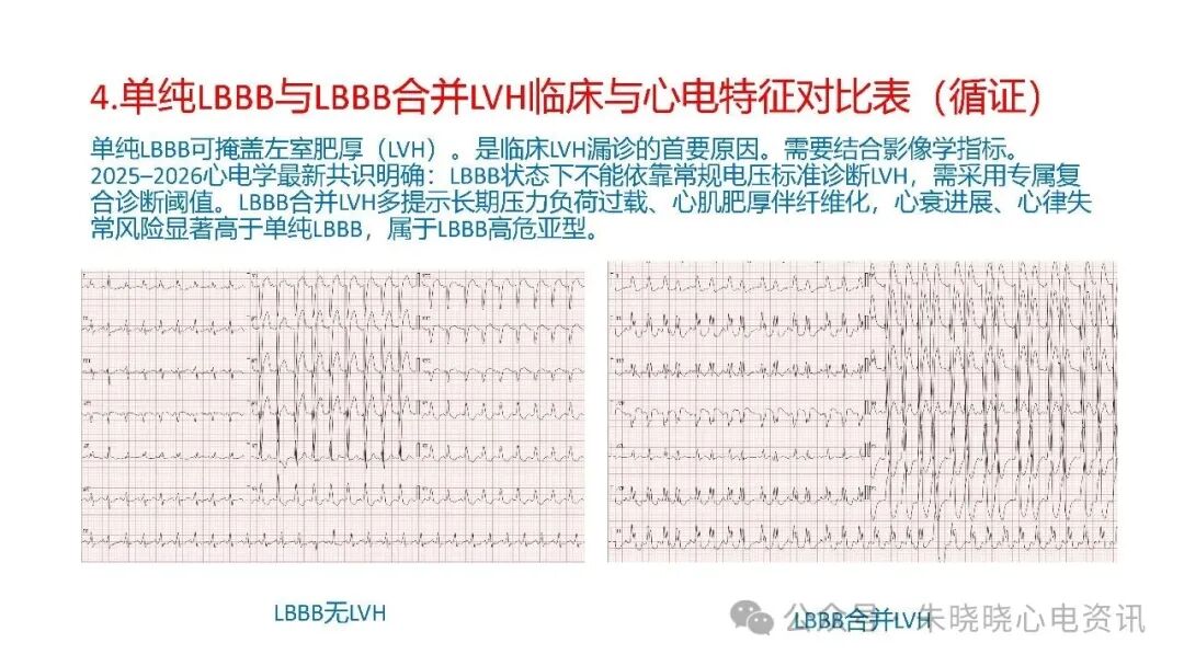 左束支阻滞再认识，实在太全了！