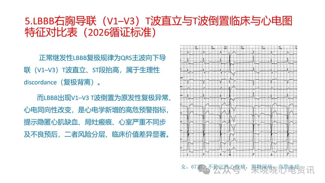 左束支阻滞再认识，实在太全了！