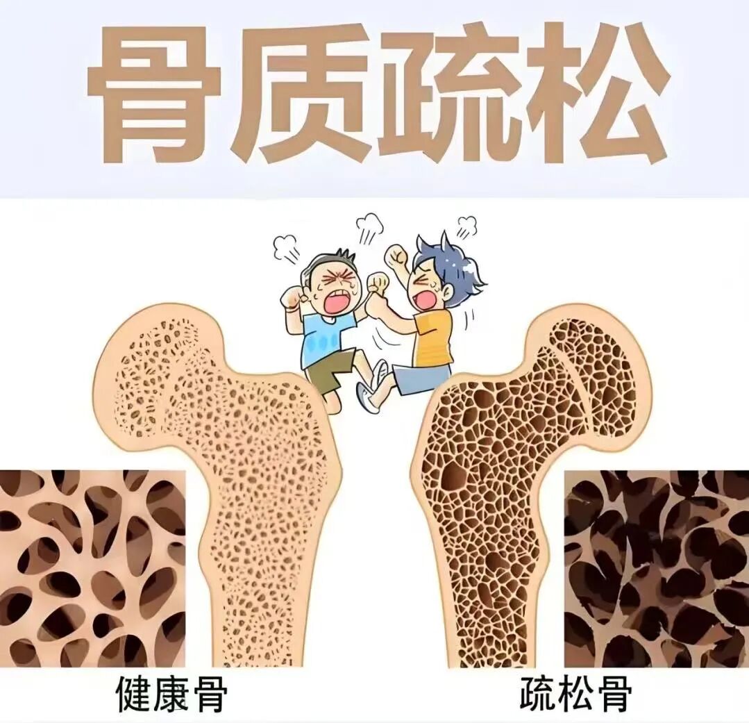 【门诊故事】没有摔跤也会骨折？揭开