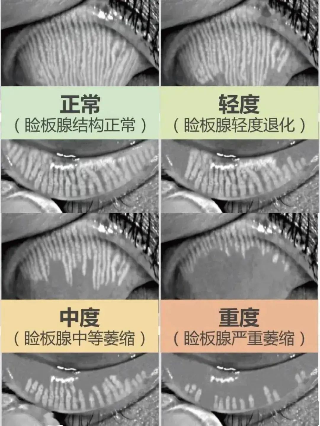 睑缘灰线示意图图片