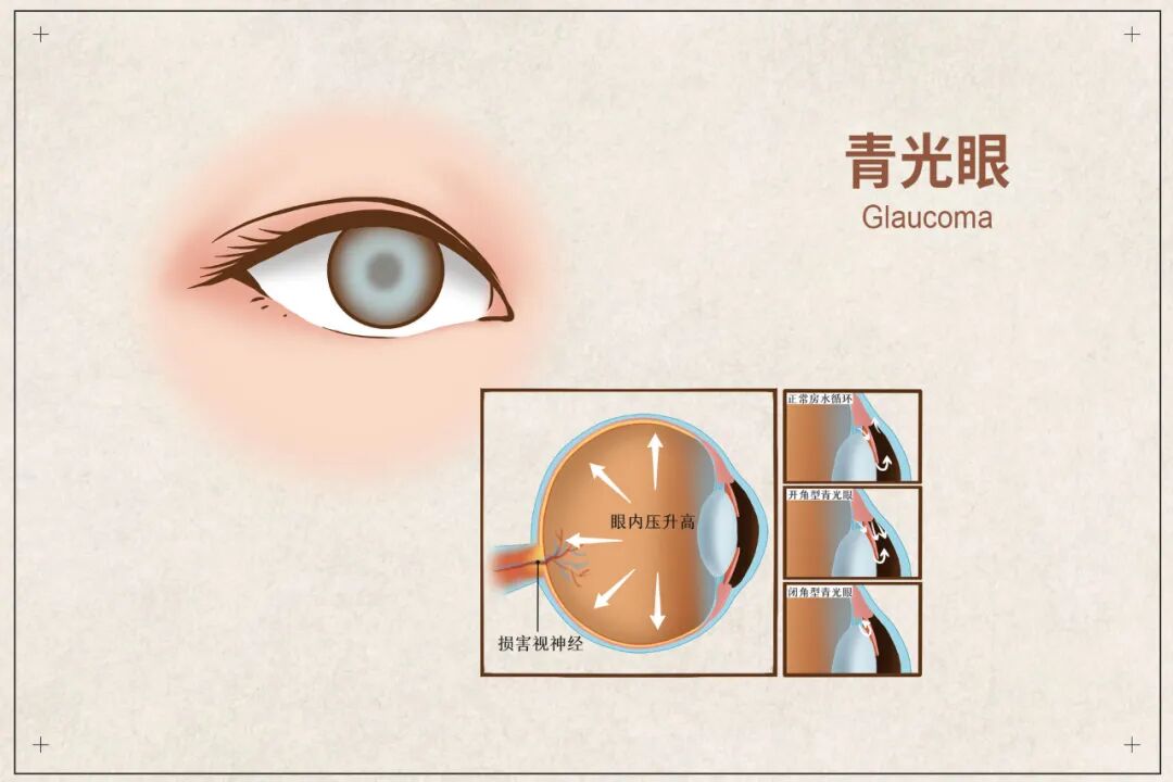世界青光眼周高眼压警报你离青光眼有多远