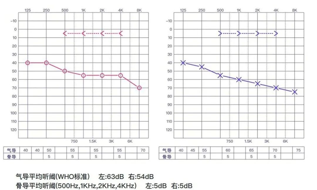感觉阀值测量怎么测耳鼻喉常见检测--纯音听阈_https://www.jmylbn.com_新闻资讯_第2张