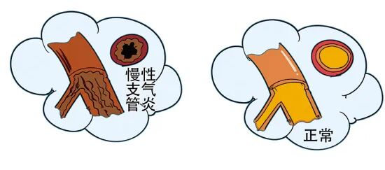 怎么呼吸麻醉常见呼吸系统疾病患者的麻醉_https://www.jmylbn.com_新闻资讯_第5张